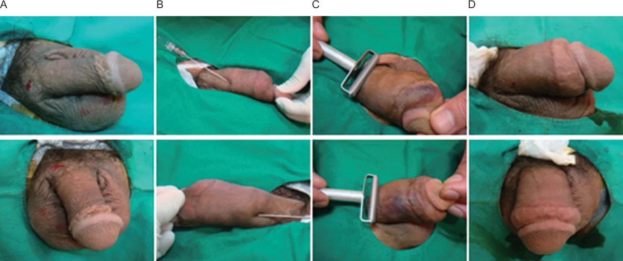 Fig 4. Secuencia fotográfica de la técnica de aumento de grosor peneano